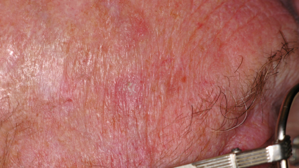 Aktiniska keratoser (Solskador)